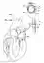 Fig. 29 - Adjustable annuloplasty devices and adjustment mechanisms therefor