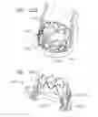 Fig. 27 - Rapid deployment prosthetic heart valve