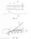 Fig. 03 - Methods of using multilayer medical sponges