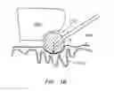 Fig. 04 - Methods of using multilayer medical sponges