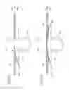 Fig. 04 - Diverticulum treating device