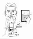 Fig. 13 - Devices, systems and methods for detecting a bilateral differential in olfactory threshold for pure odorants