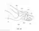 Fig. 02 - DEVICES FOR BONE FIXATION USING AN INTRAMEDULLARY FIXATION IMPLANT