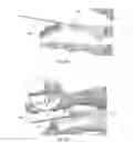 Fig. 14 - DEVICES FOR BONE FIXATION USING AN INTRAMEDULLARY FIXATION IMPLANT