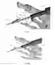 Fig. 17 - DEVICES FOR BONE FIXATION USING AN INTRAMEDULLARY FIXATION IMPLANT