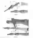 Fig. 18 - DEVICES FOR BONE FIXATION USING AN INTRAMEDULLARY FIXATION IMPLANT