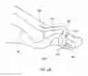 Fig. 02 - Methods for bone fixation using an intramedullary fixation implant