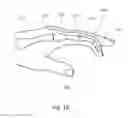 Fig. 03 - Methods for bone fixation using an intramedullary fixation implant