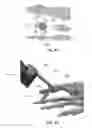 Fig. 12 - Methods for bone fixation using an intramedullary fixation implant