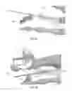 Fig. 14 - Methods for bone fixation using an intramedullary fixation implant