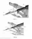 Fig. 17 - Methods for bone fixation using an intramedullary fixation implant