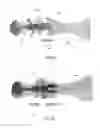Fig. 19 - Methods for bone fixation using an intramedullary fixation implant
