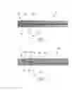 Fig. 02 - Method and apparatus for trabeculectomy and suprachoroidal shunt surgery