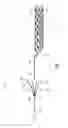Fig. 02 - Mechanical thrombectomy with proximal occlusion