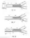 Fig. 07 - Mechanical thrombectomy with proximal occlusion