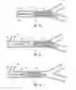 Fig. 08 - Mechanical thrombectomy with proximal occlusion