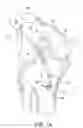 Fig. 02 - Tissue graft anchoring