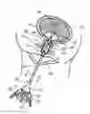 Fig. 01 - SYSTEM AND METHOD FOR TREATING URINARY TRACT DISORDERS