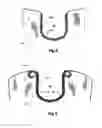 Fig. 06 - Fenestrated stent grafts