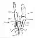 Fig. 01 - Device and method for hallux valgus repair by intermedullary spring clip
