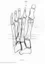Fig. 02 - Device and method for hallux valgus repair by intermedullary spring clip