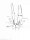 Fig. 08 - Device and method for hallux valgus repair by intermedullary spring clip