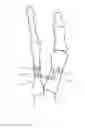 Fig. 09 - Device and method for hallux valgus repair by intermedullary spring clip