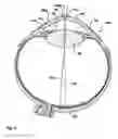 Fig. 02 - Technique for controlling a corneal ablation laser