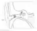 Fig. 01 - HYBRID HEARING DEVICE