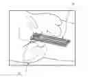 Fig. 01 - Brachytherapy apparatus