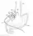Fig. 01 - Laparoscopic lead implantation method