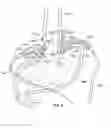 Fig. 07 - Laparoscopic lead implantation method