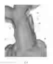 Fig. 06 - NON-INVASIVE EVALUATION OF FIT AND SIZING OF DEVICE PRIOR TO IMPLANT