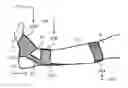 Fig. 01 - Apparatus having brace assembly for muscle