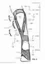 Fig. 06 - Apparatus having brace assembly for muscle