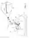 Fig. 02 - Delivering ocular implants into the eye