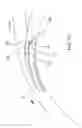 Fig. 19 - Delivering ocular implants into the eye