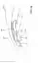 Fig. 20 - Delivering ocular implants into the eye