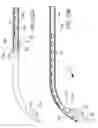 Fig. 25 - Delivering ocular implants into the eye