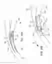 Fig. 29 - Delivering ocular implants into the eye