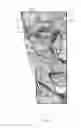 Fig. 04 - Apparatus and method for treating a neuromuscular defect