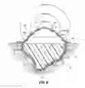 Fig. 10 - Wound dressing with vacuum reservoir