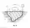 Fig. 11 - Wound dressing with vacuum reservoir