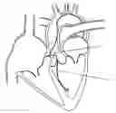 Fig. 01 - Convertible Shape Catheter And Method Of Use