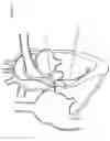 Fig. 04 - Convertible Shape Catheter And Method Of Use