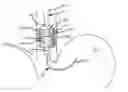 Fig. 01 - Unfurling electrode devices with spring