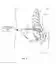 Fig. 02 - Electrical stimulation therapy for lower urinary tract dysfunction and sexual reflex dysfunction