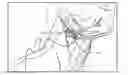 Fig. 01 - System for stimulating a hypoglossal nerve for controlling the position of a patient's tongue