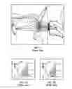Fig. 02 - System for stimulating a hypoglossal nerve for controlling the position of a patient's tongue