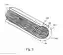 Fig. 04 - Stent-mesh assembly and methods